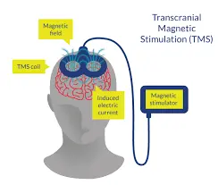 transcranial magnetic stimulation treatment centers transcranial magnetic stimulation treatment