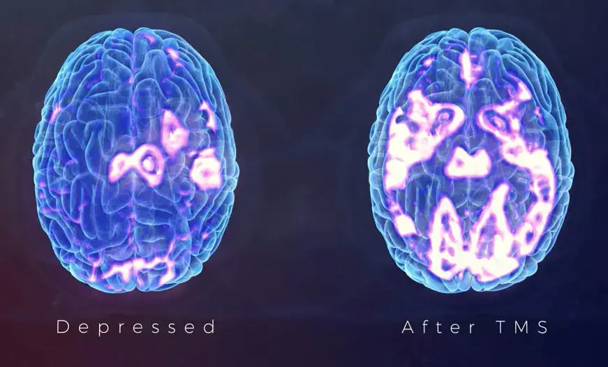 individualized-tms-therapy-west-virginia transcranial magnetic stimulation treatment centers and care