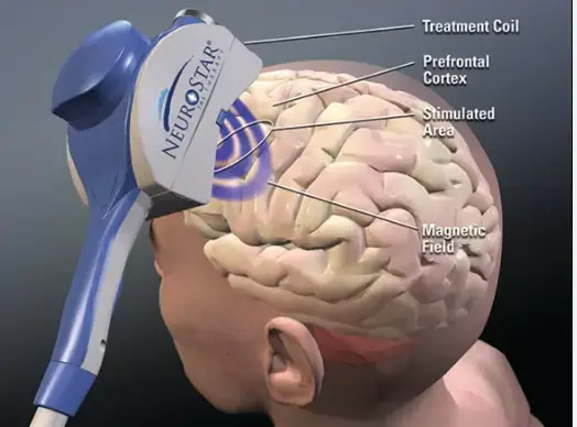 west-virginia-individualized-tms-therapy TMS treatment centers for depression and mental health